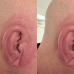 Doug Ear Story